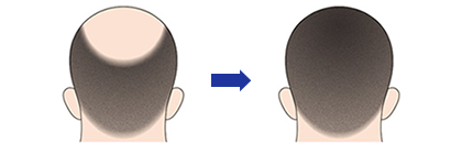 頭頂部/前髪等の広範囲の薄毛の修復