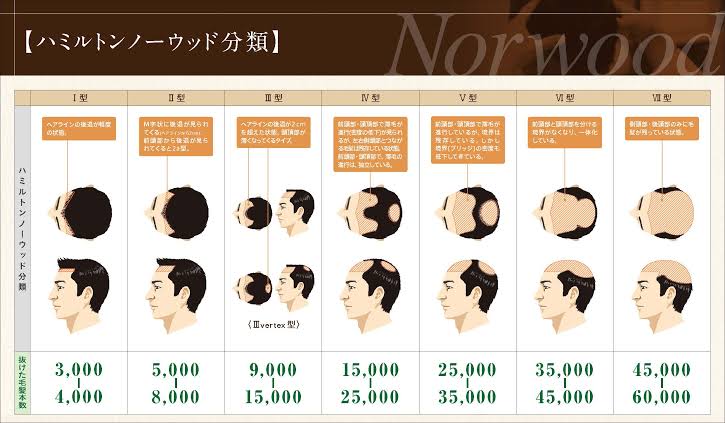 ハミルトンノーウッド分類と抜けた本数に関する質問