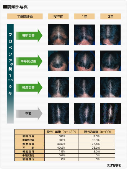 プロペシアの長期服用について（追伸）