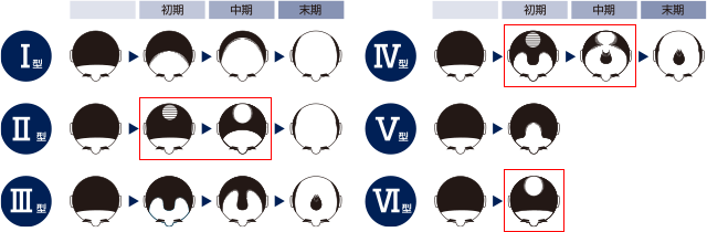 リアップが効く人、効かない人。