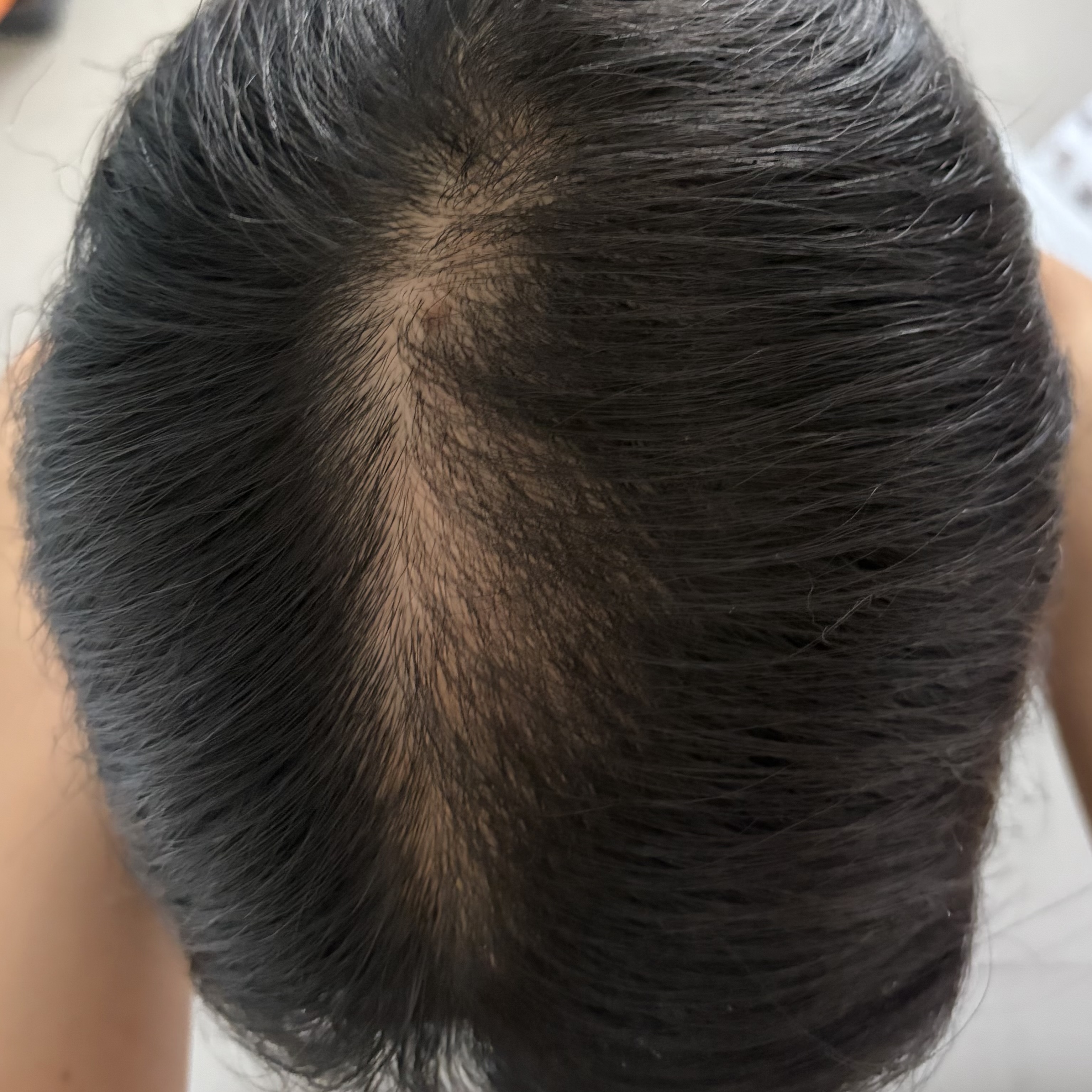 抜毛症、生えるのか