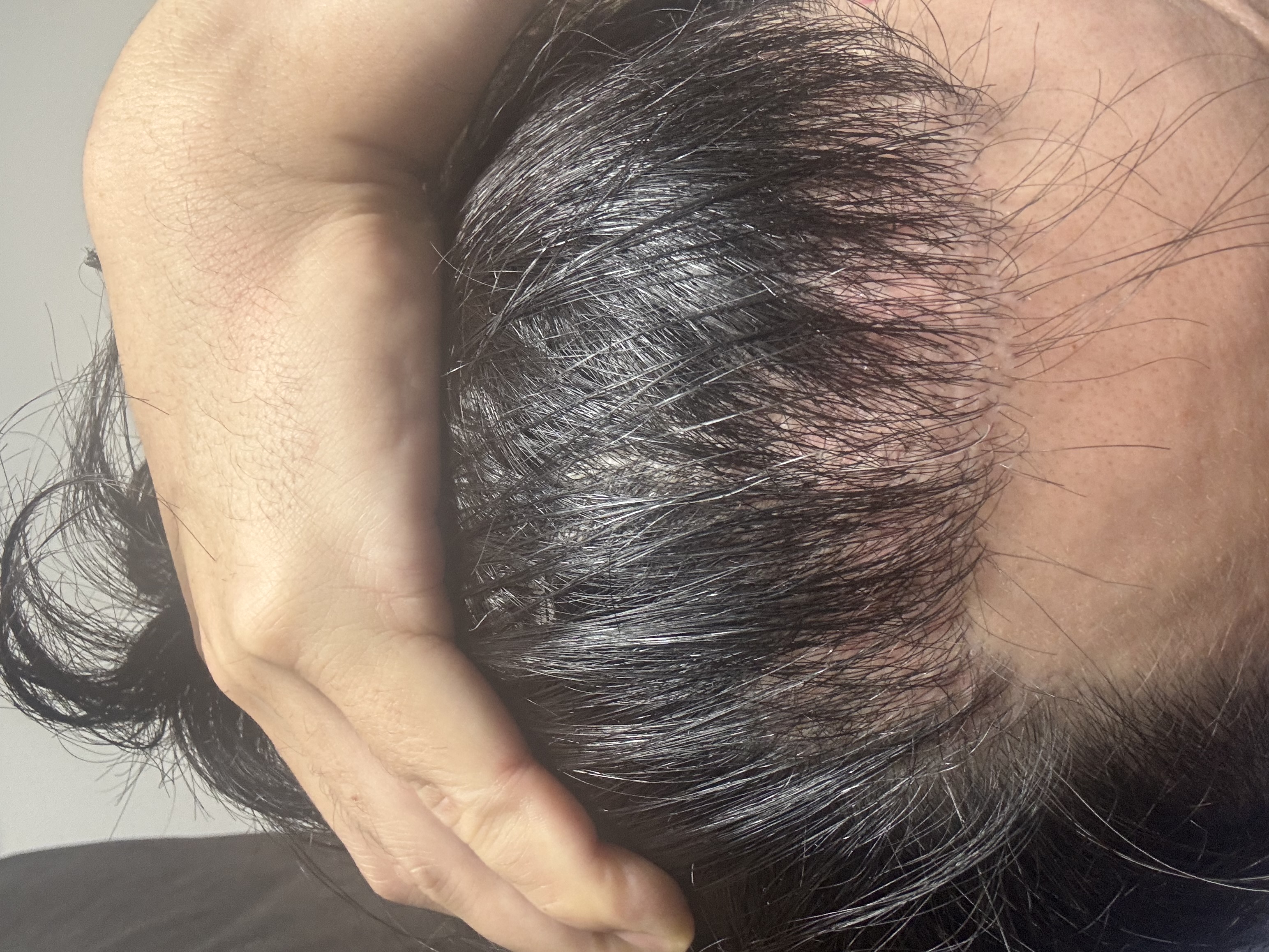 2回目植毛後のショックロスについて