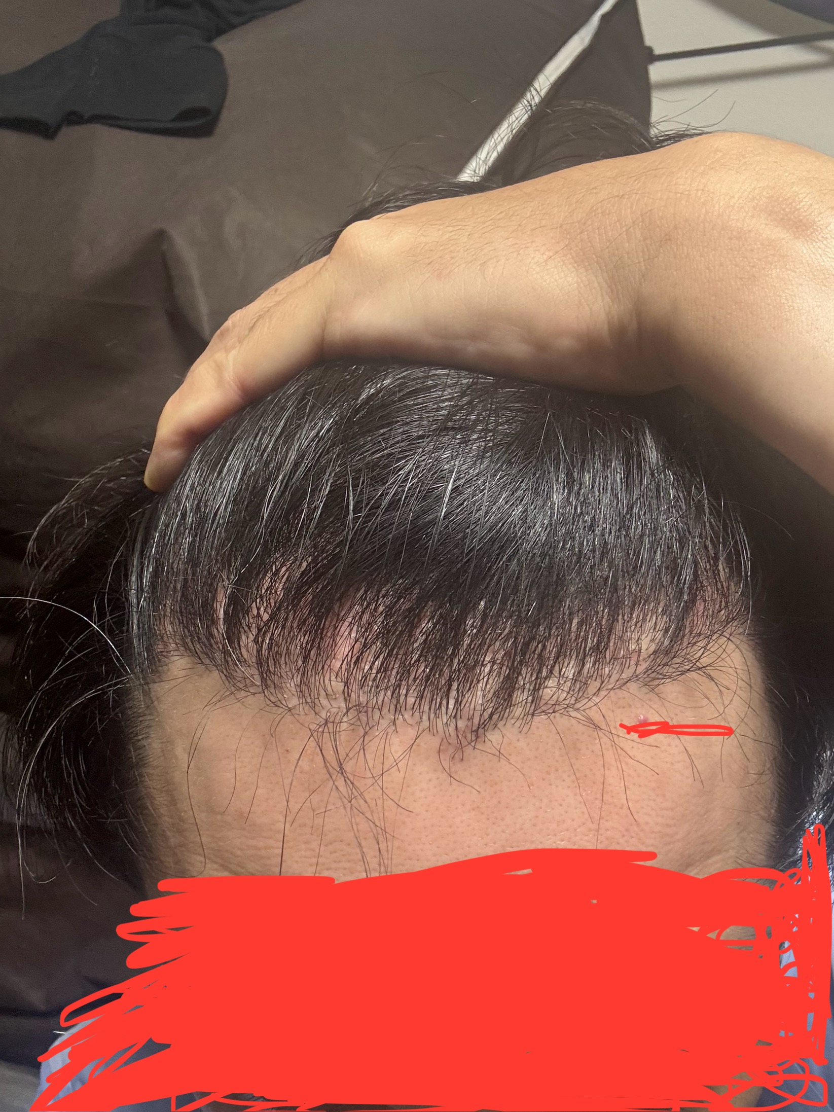 2回目植毛後のショックロスについて